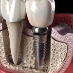 dental materials and product suppliers in Kerala